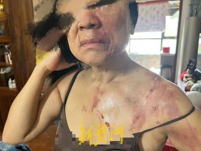 6t体育破壁机打豆浆时“爆喷”烫伤老人苏泊尔：已无第一现场质疑老人误操作